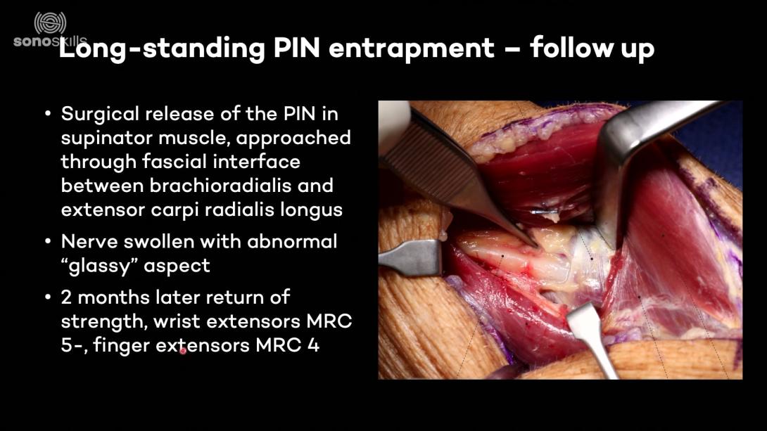 Radial neuropathy - PIN entrapment