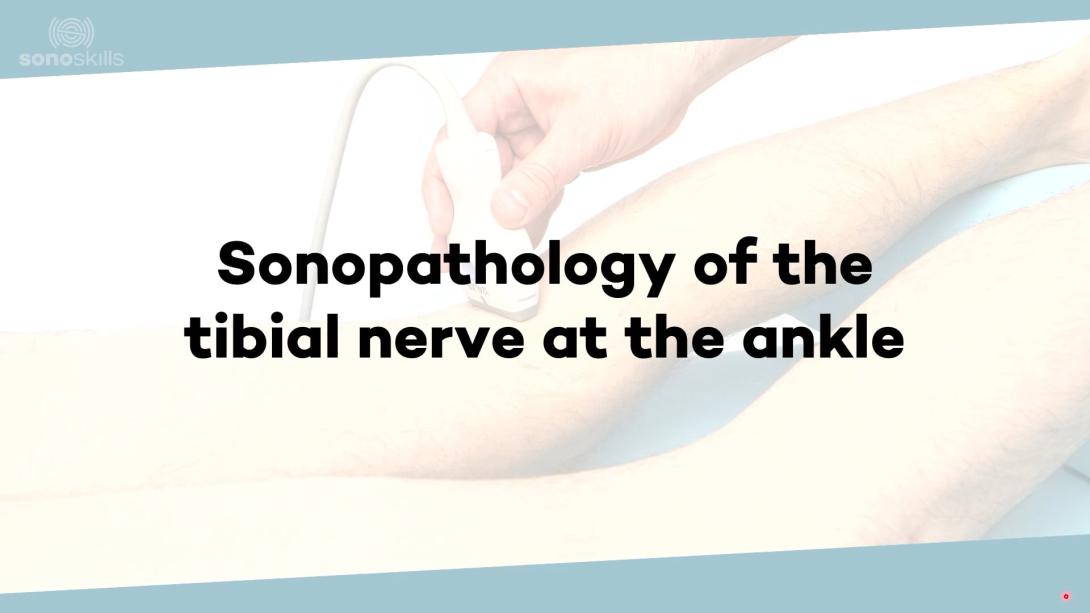 (Sono)pathology of the tibial neuropathy - ankle