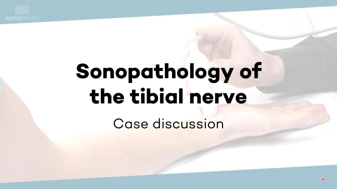 Sonopathology of the tibial nerve - Part 1