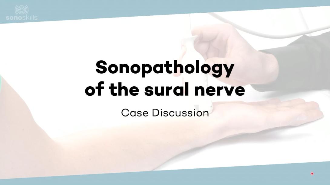Sonopathology of the sural nerve - Part 1
