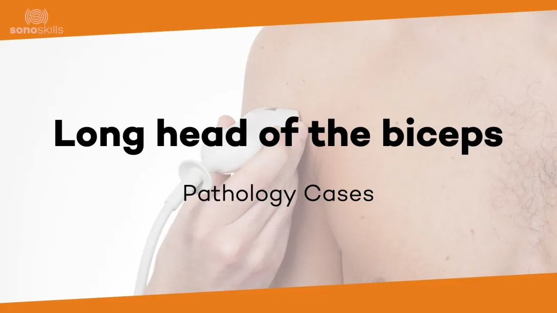Biceps case # 4 (64 year old man with biceps dislocation, tear of SSC and supra)