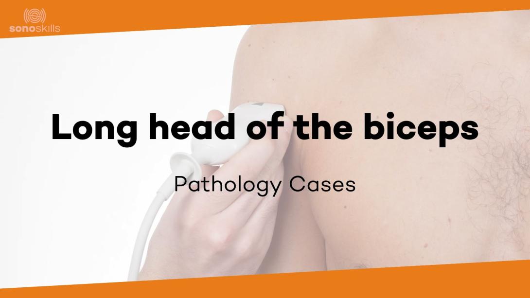 Biceps case # 4 (64 year old man with biceps dislocation, tear of SSC and supra)