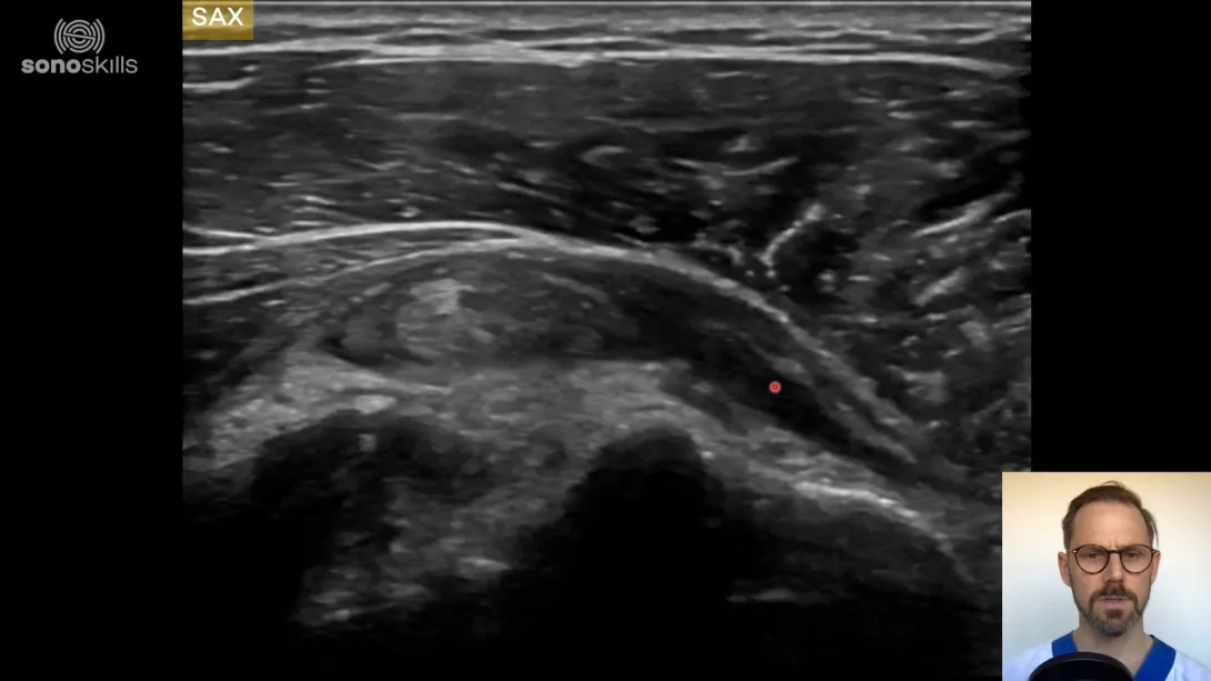 Biceps case #5 (65 year old man with biceps luxation, SSC, Supra, Infra. Intact Teres Minor)