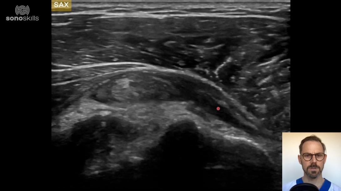 Biceps case #5 (65 year old man with biceps luxation, SSC, Supra, Infra. Intact Teres Minor)