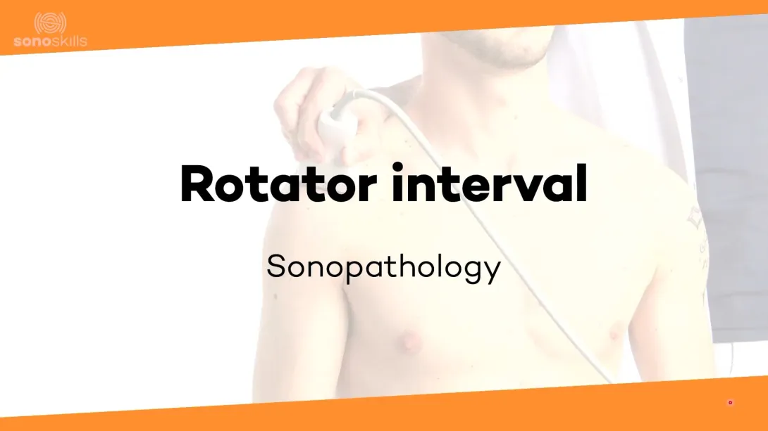 Rotator interval - sonopathology 