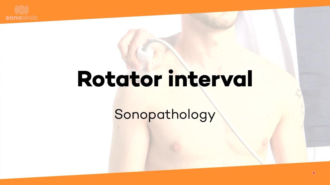 Rotator interval - sonopathology 