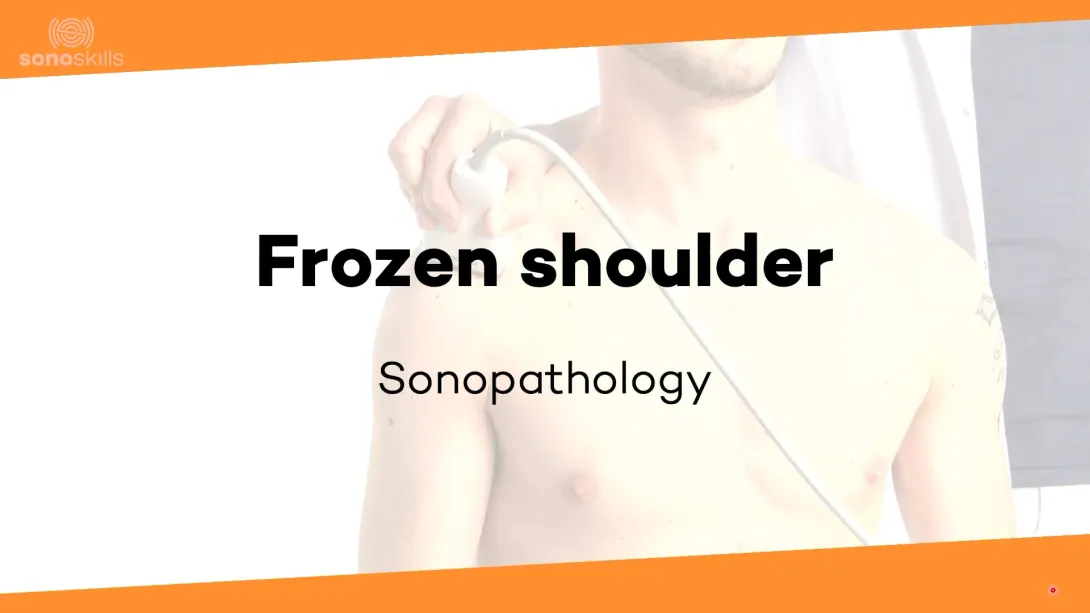 Frozen shoulder - sonopathology