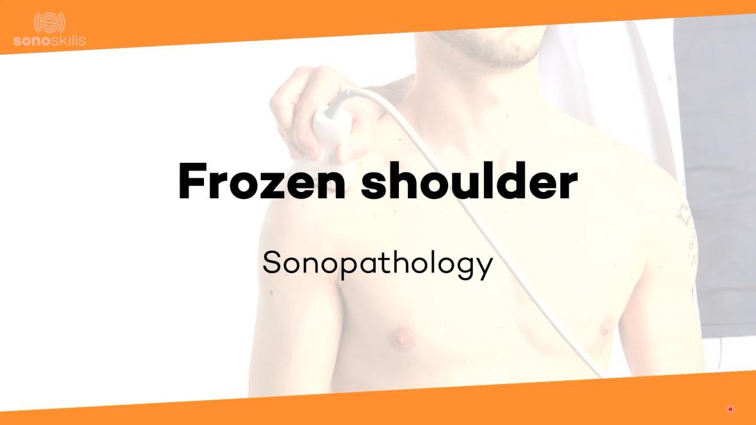 Frozen shoulder - sonopathology