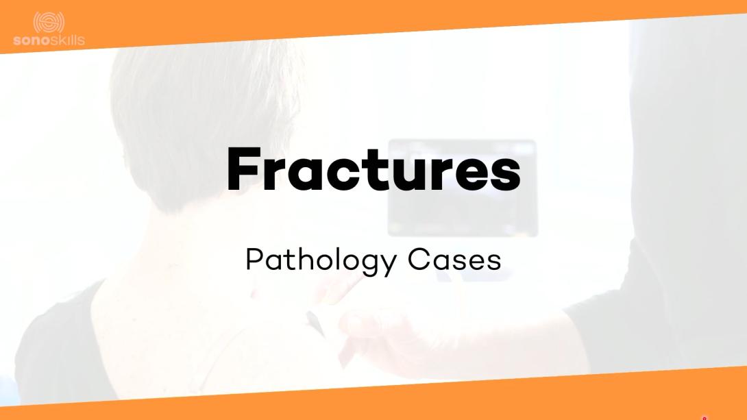 Subscapularis case # 3 (34 yr Man, fractured lesser tubercle)