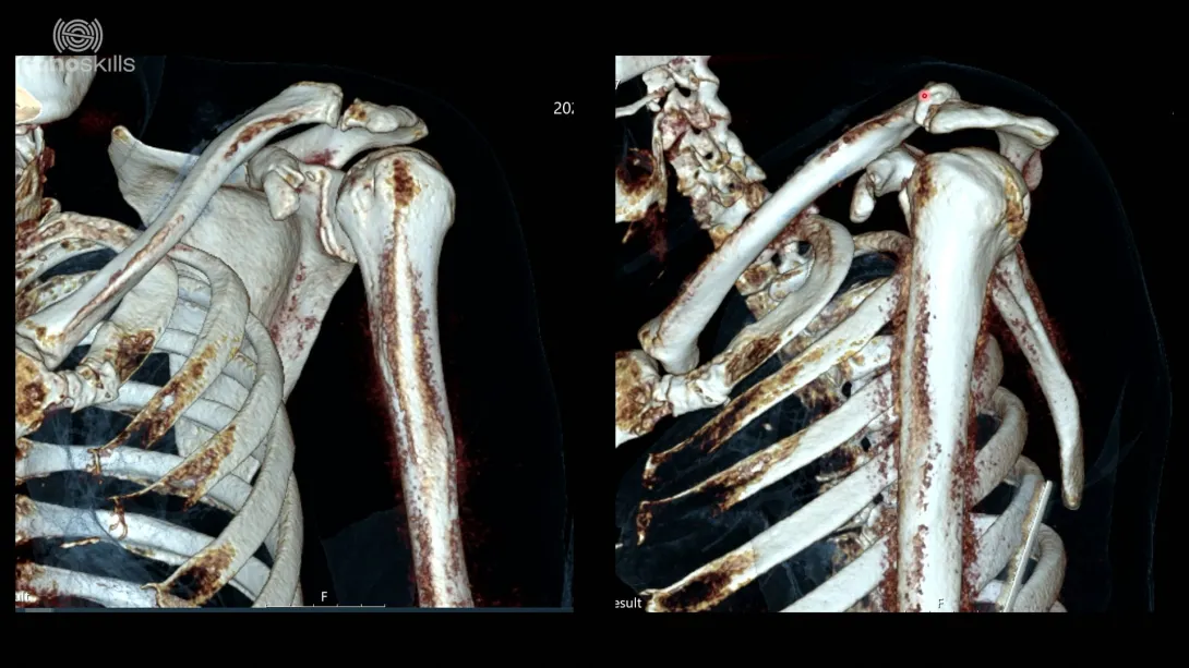 Coracoid process case (58 year old man with fracture of the Coracoid Process)