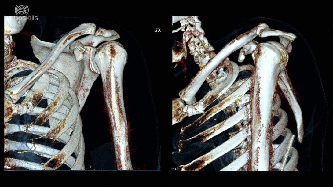 Coracoid process case (58 year old man with fracture of the Coracoid Process)