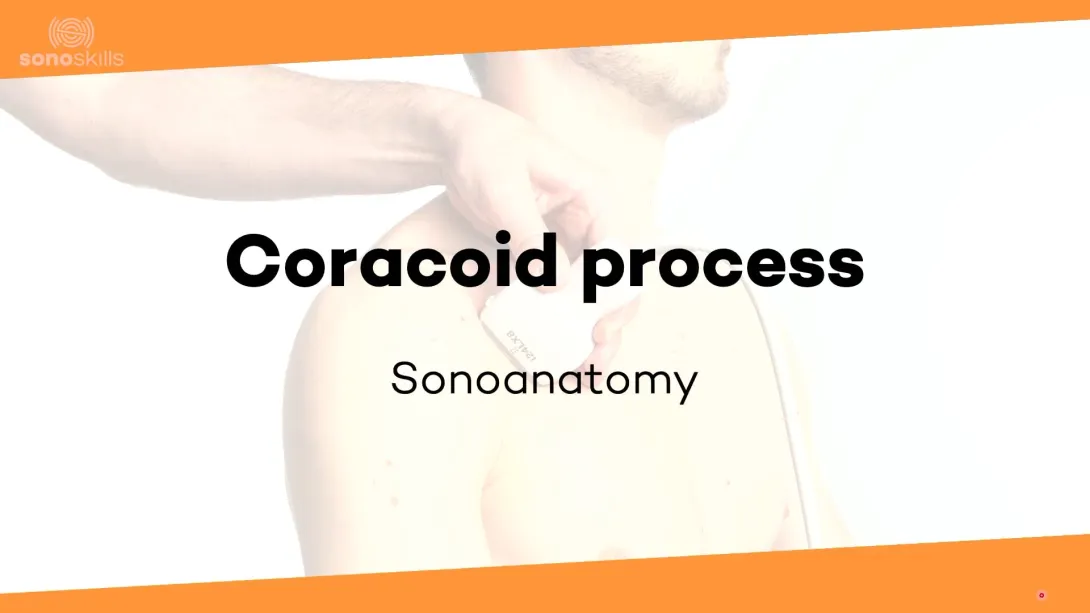 Coracoid process - sonoanatomy