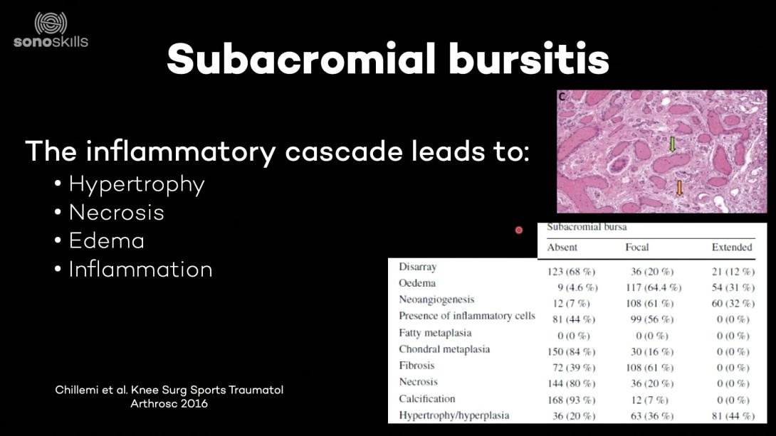 Pathology subacromial bursitis