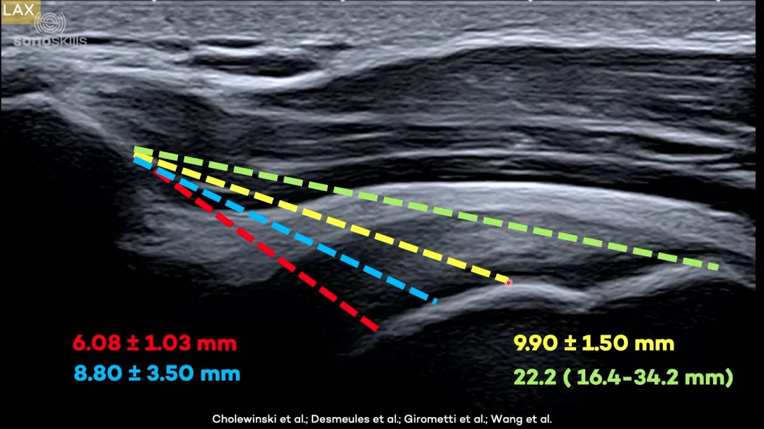 Supraspinatus subacromial - sonoanatomy