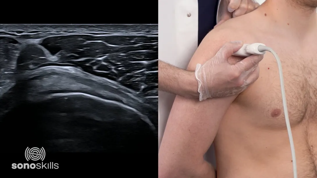 Supraspinatus tendon - hands on SAX Crass