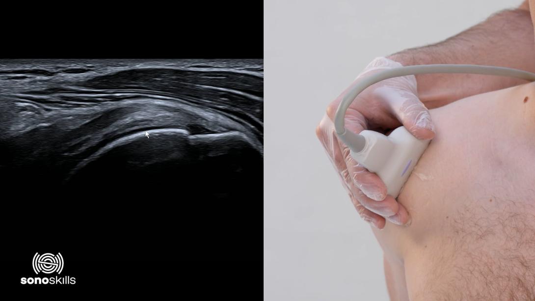 Supraspinatus tendon detailed 2 - hands on LAX