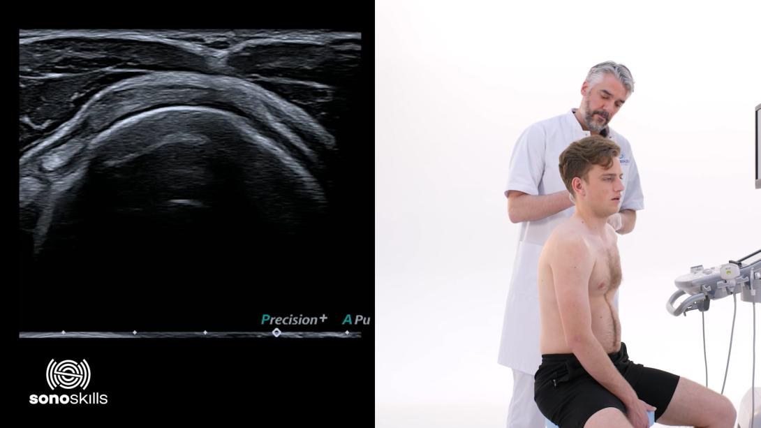 Supraspinatus tendon measurements - hands on SAX + LAX