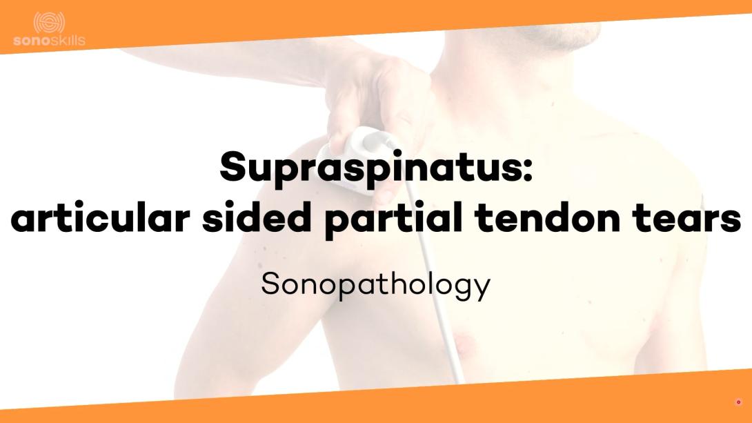 Supraspinatus articular sided partial tendon tears - sonopathology