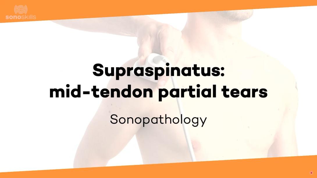 Supraspinatus mid tendon partial tendon tears - sonopathology