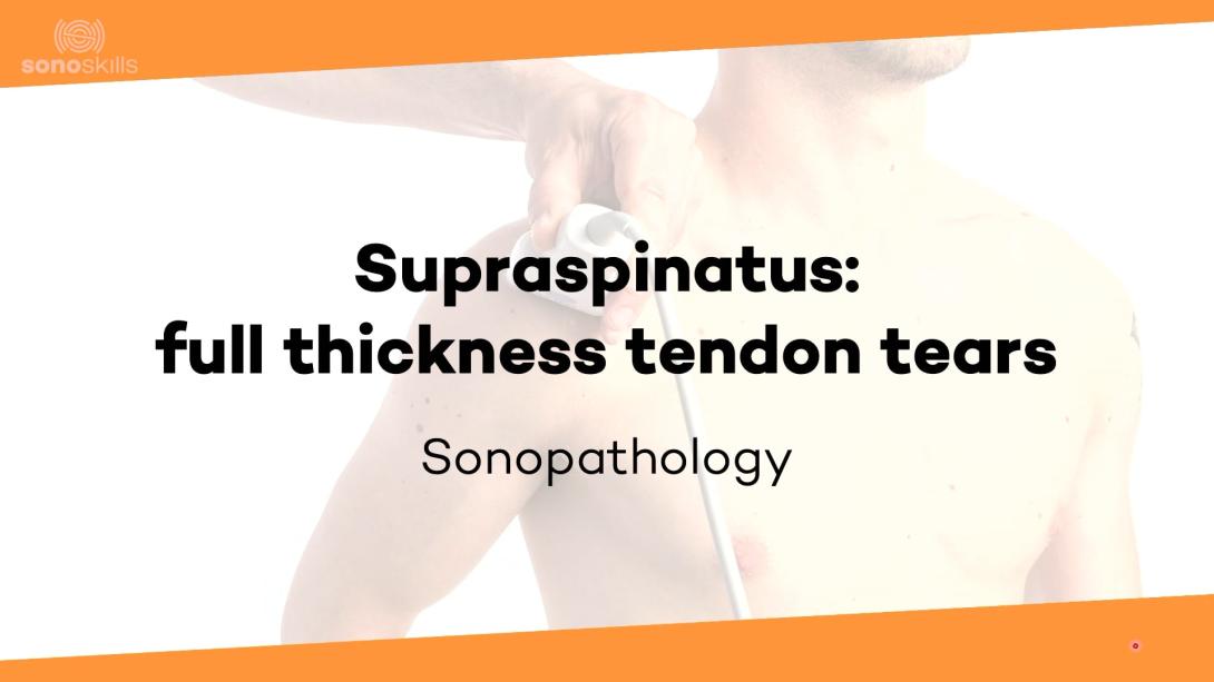 Supraspinatus full thickness tendon tears - sonopathology