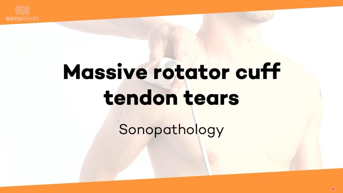 Massive rotator cuff tears - sonopathology