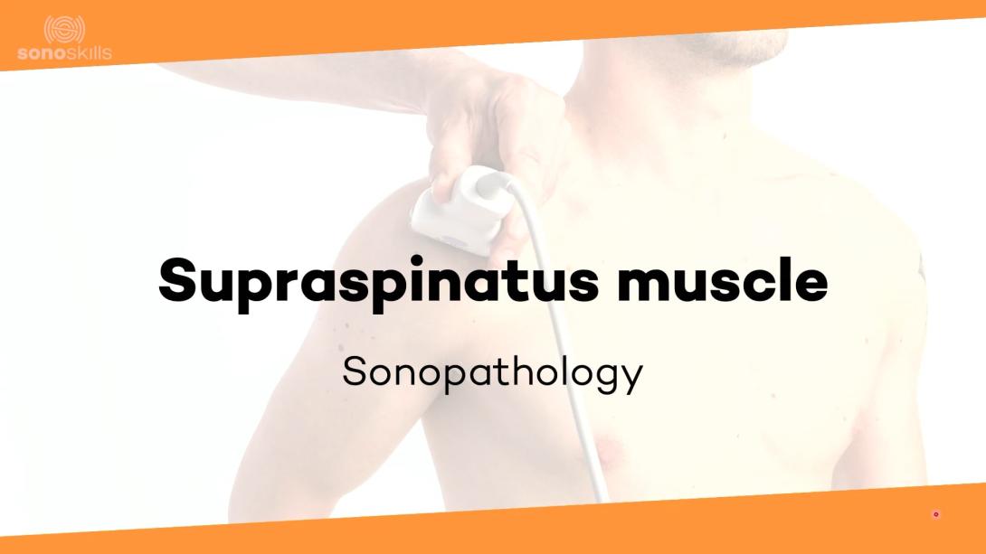 Supraspinatus muscle - sonopathology
