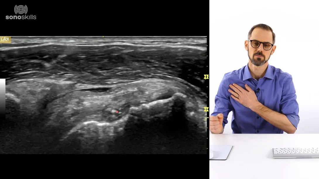 Supraspinatus case #3 (70 yr old man with Cuff tear not suitable for suture)