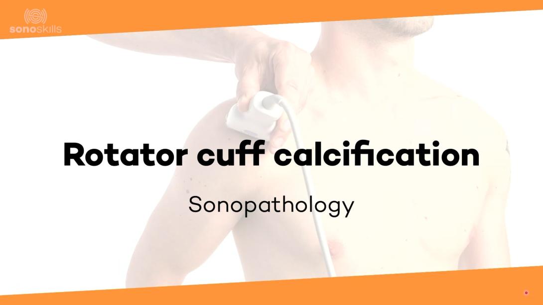 Rotator cuff calcification - sonopathology