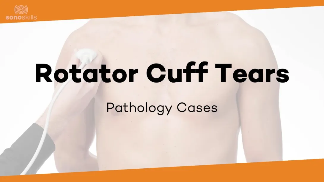 Supraspinatus case #6 (82 yr man, dislocated biceps massive degenerative cuff tear)
