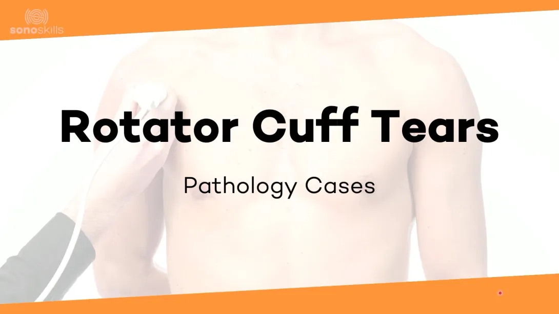 Supraspinatus case # 7 (77 year old man Massive Cuff Tear)