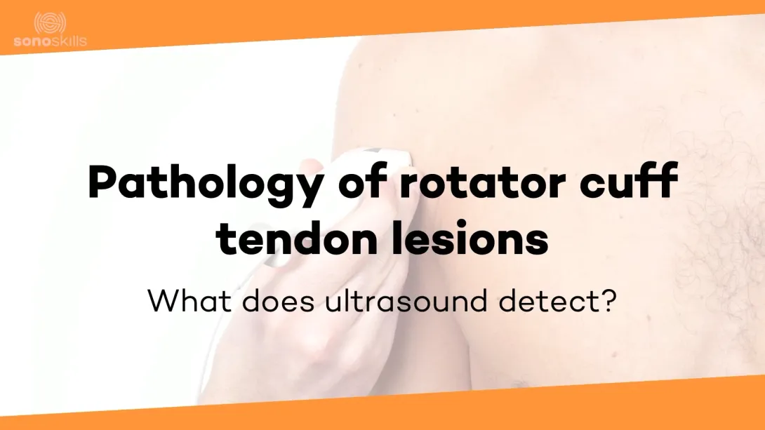Pathology tendon disorders rotator cuff