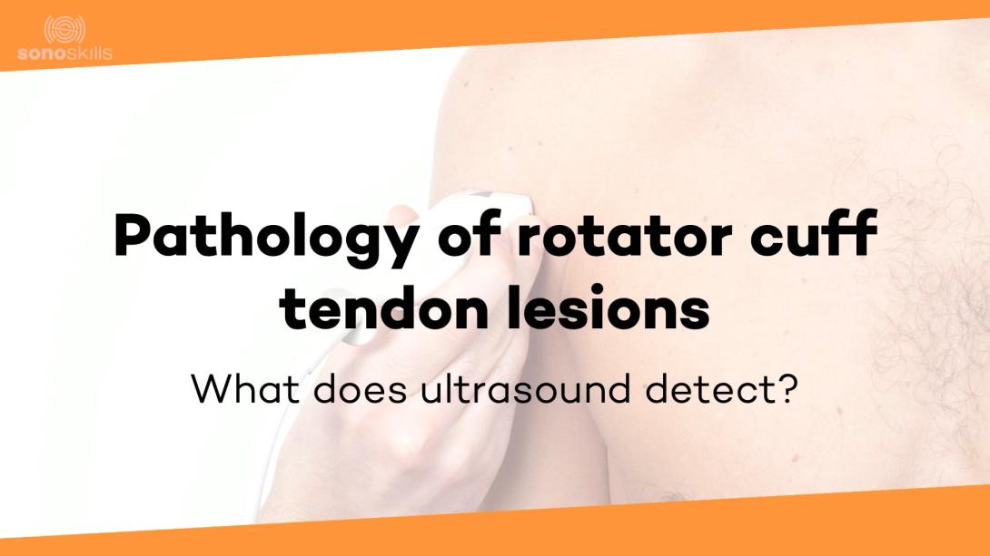 Pathology tendon disorders rotator cuff