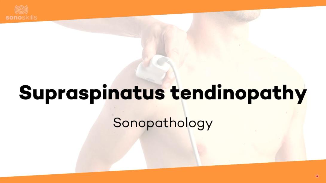 Supraspinatus tendinopathy - sonopathology