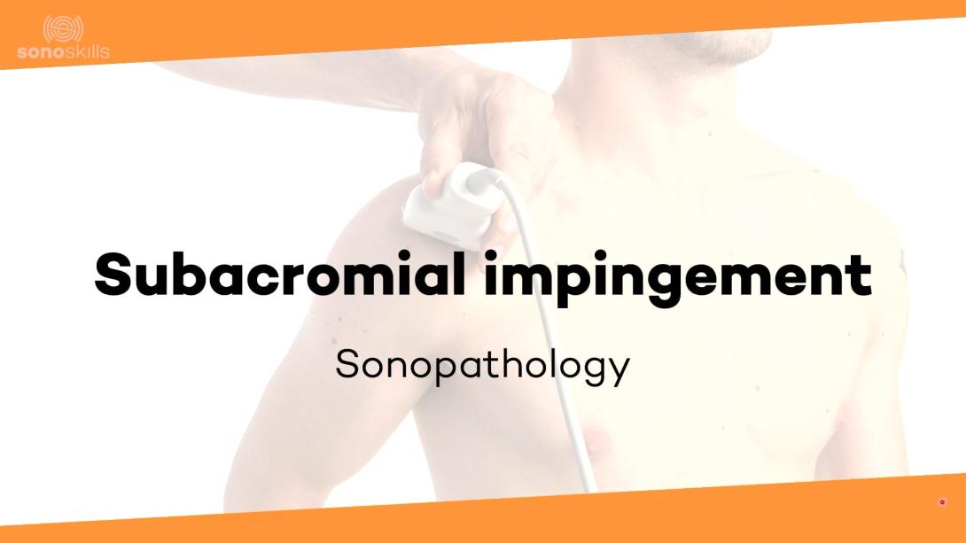 Subacromial impingement - sonopathology