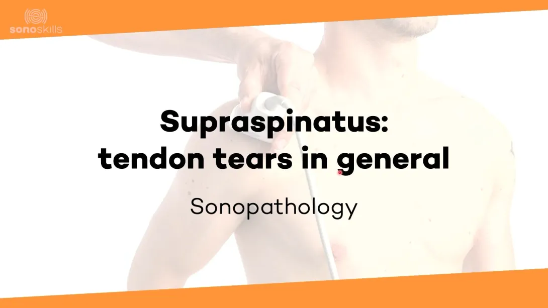 Supraspinatus tendon tears in general - sonopathology