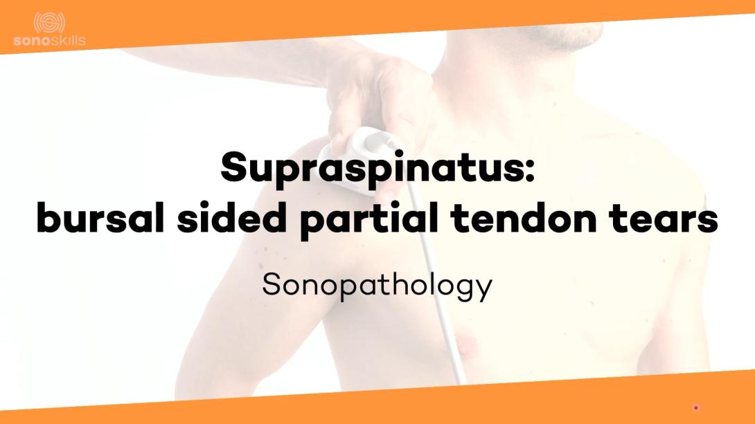 Supraspinatus bursal sided partial tendon tears - sonopathology