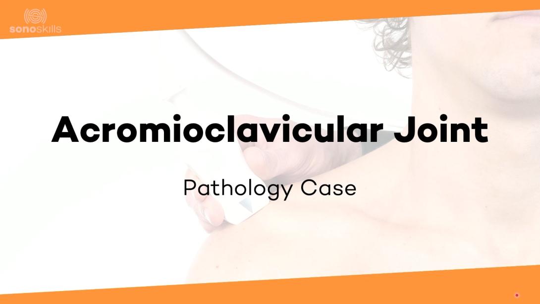 AC joint case #3 (57 yr old man with lipoma posterior to AC-joint)