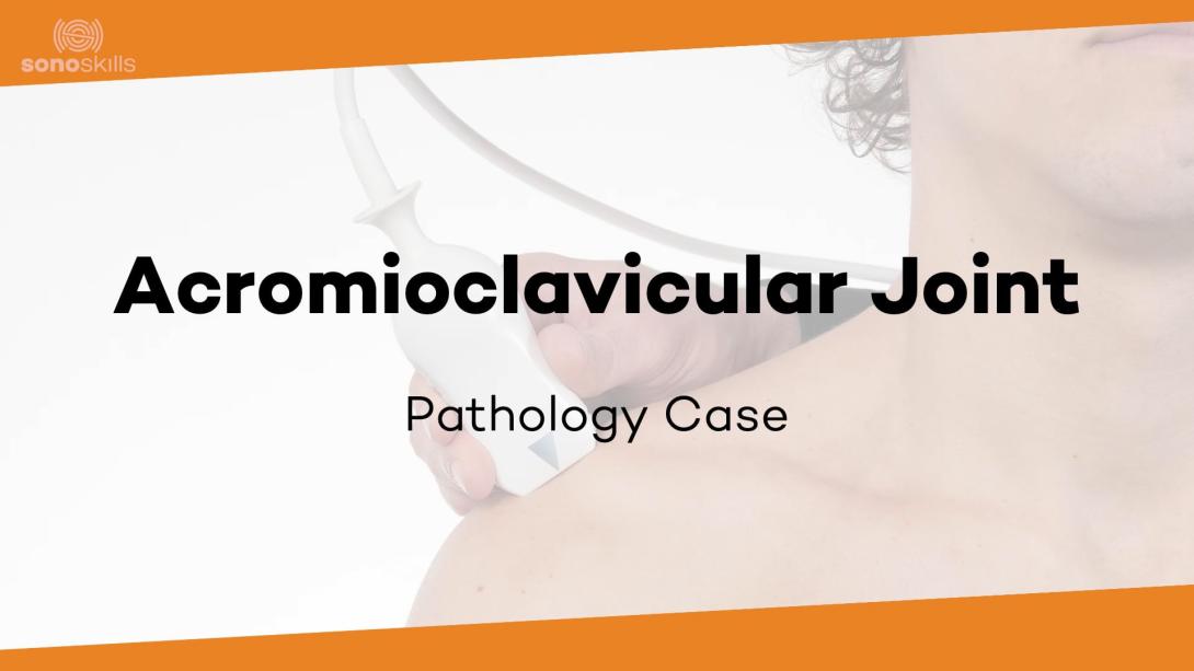 AC joint case #5 (70 yr old woman OA of the AC-joint)