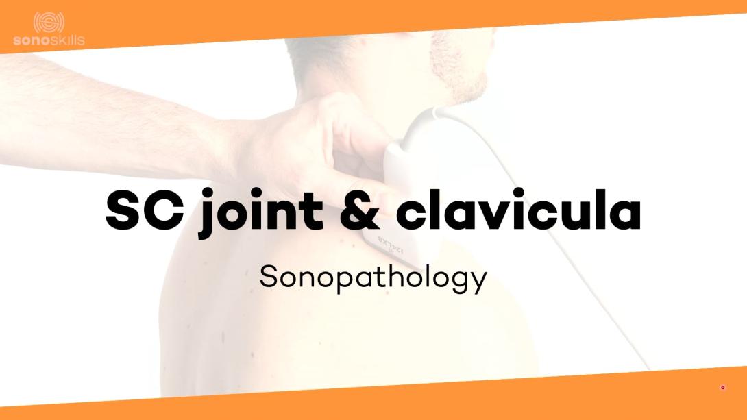 SC clavicula sonopathology