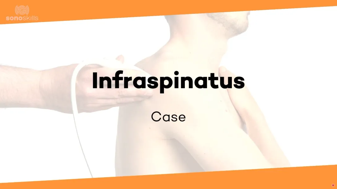 Case infraspinatus