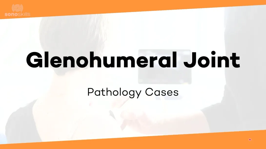 Glenohumeral joint case #3 (45-year old woman with hypermobility but also OA)