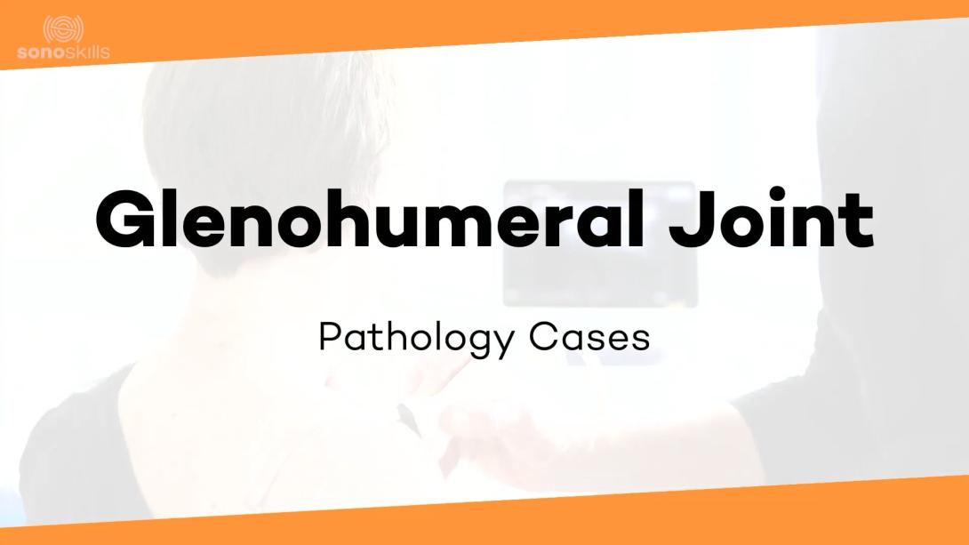 Glenohumeral joint case #6 (63 yr Man Paralabral cyst and aspiration)