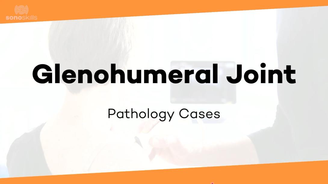 Glenohumeral joint case #8 (64 yr old woman with OA and then Prosthesis)