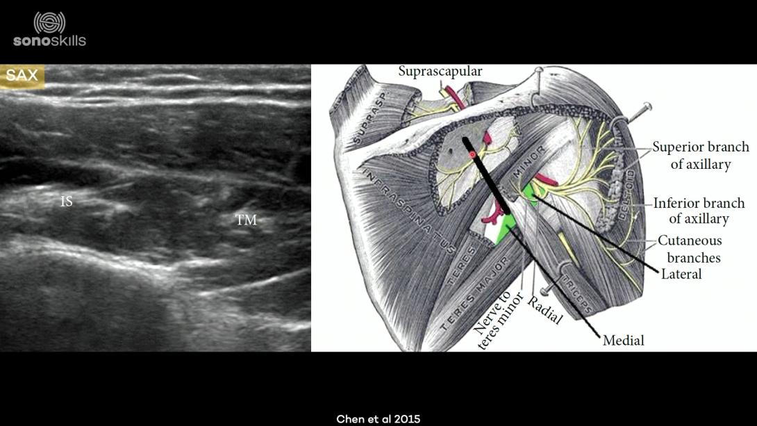 Axillary nerve and quadrilateral space - anatomy and sonoanatomy