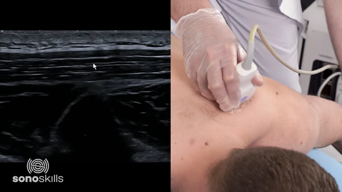 Trapezius muscle demonstration