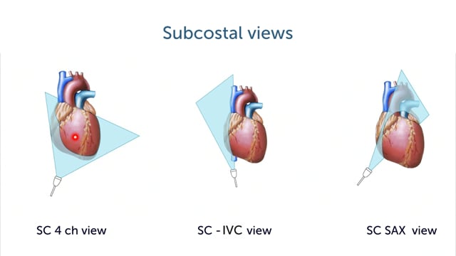 How can I find the heart in a subcostal view?